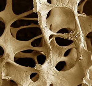 Paratiroidi e Osteoporosi